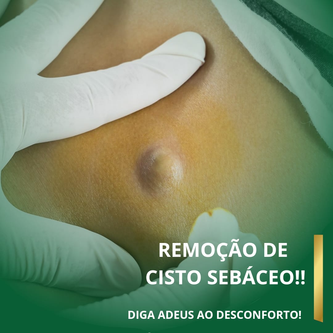 Remocao-de-Cisto-Sebaceos.jpeg
