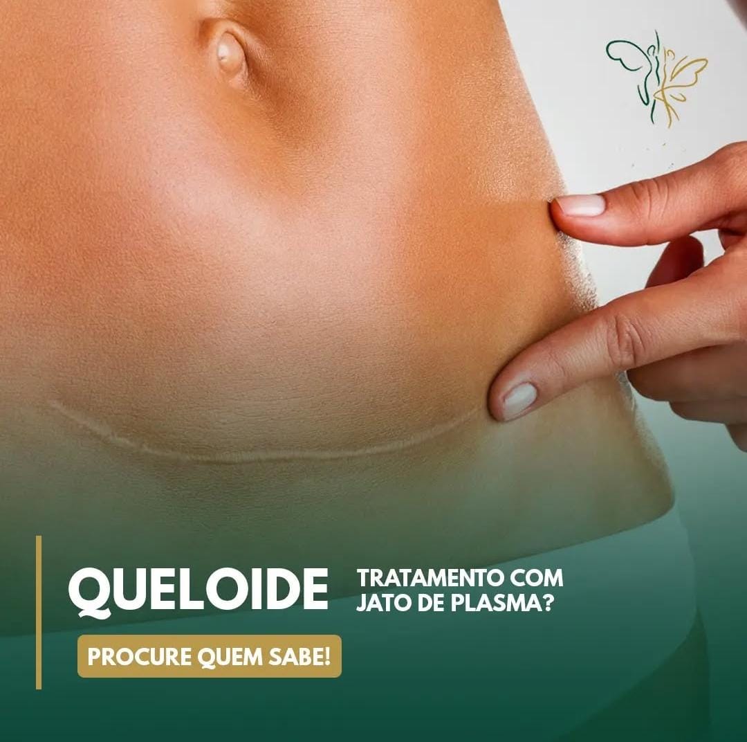 Tratamento-de-jato-de-Plasma-Queloide.jpeg