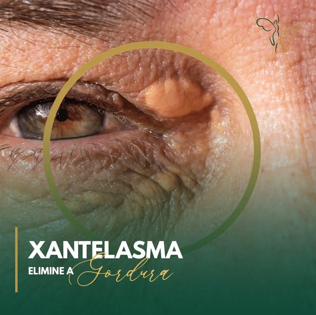 Xantelasma-1.jpeg